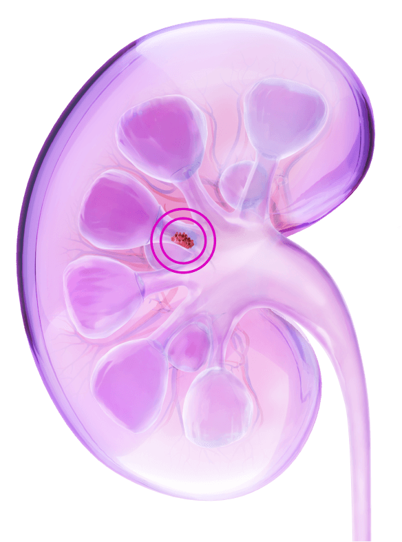 Kidney illustration with circled tumor