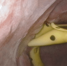 Image of 3-months-later tumor