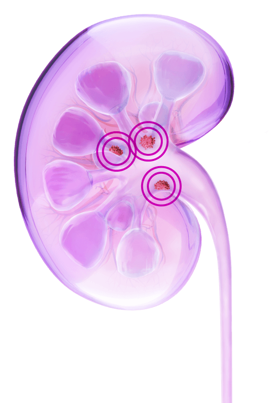 Kidney illustration with circled tumors