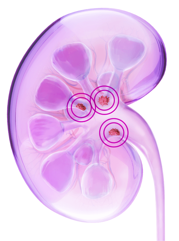 Kidney illustration with circled tumors