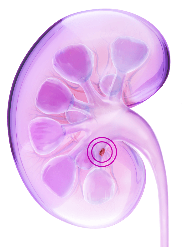 Kidney illustration with circled tumor