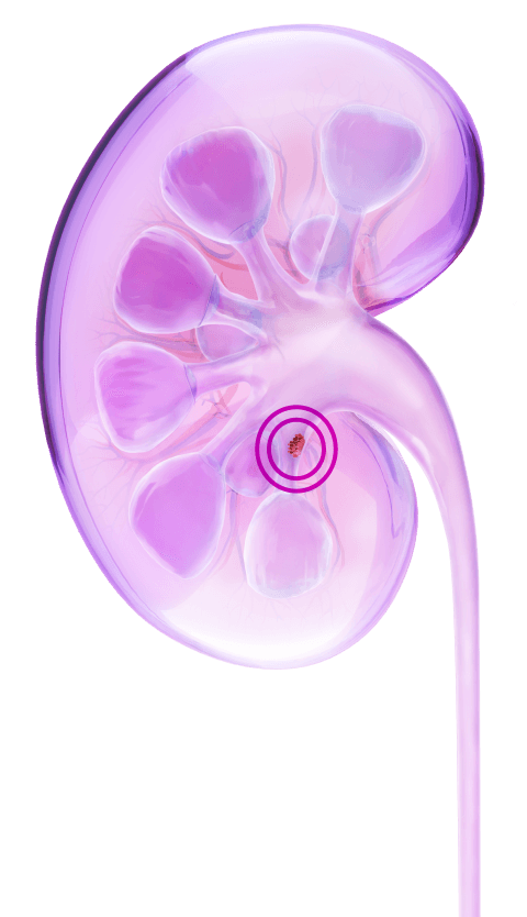Kidney illustration with circled tumor