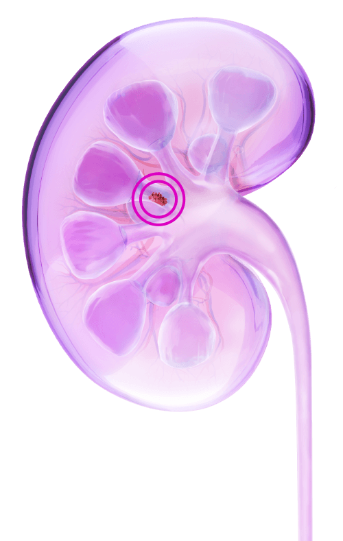 Kidney illustration with circled tumor