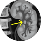 CT scan of large tumor