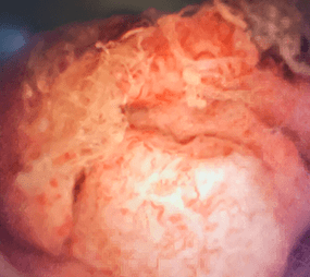 Image of large tumor