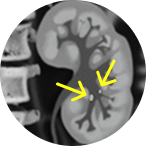 CT scan of multi-focal tumor