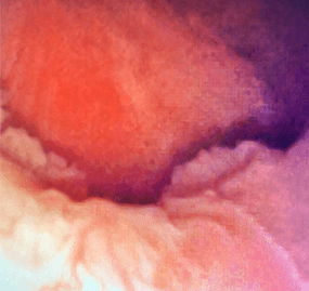 Image of multi-focal tumor