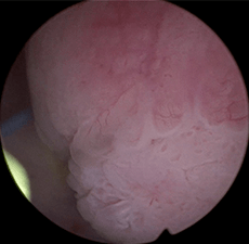 Image of prior-to-treatment tumor