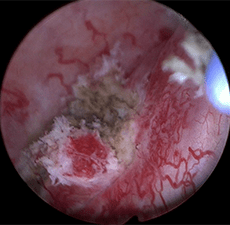 Image of residual tumor