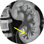 CT scan of unresectable tumor