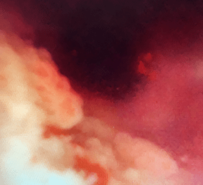 Image of unresectable tumor