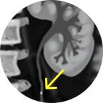 CT scan of ureteral tumor