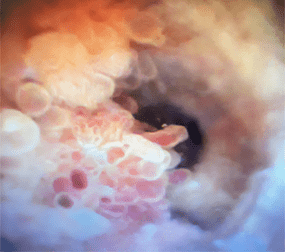 Image of ureteral tumor